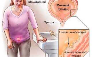 Боль после мочеиспускания у женщин