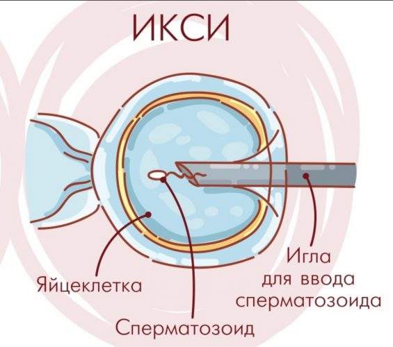 процедура ИКСИ
