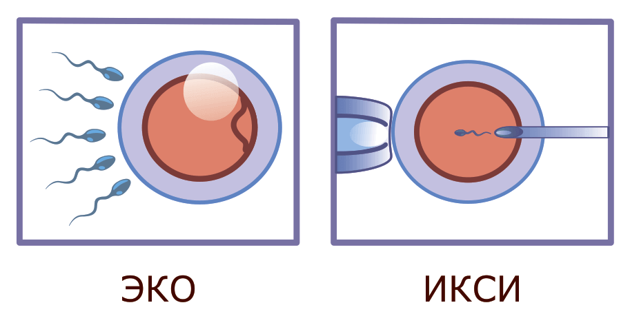 отличие ЭКО от ИКСИ