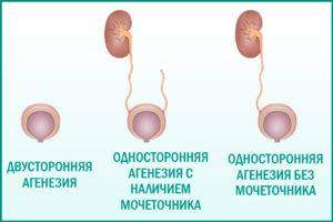 agenezija-pochki-300x200.jpg