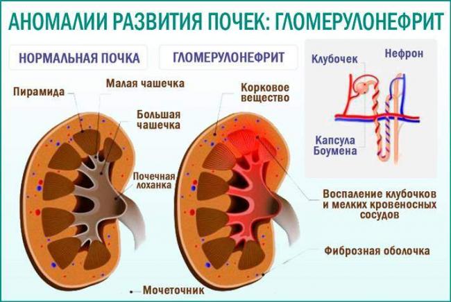 Anomalii-razvitija-pochek-glomerulonefrit.jpg