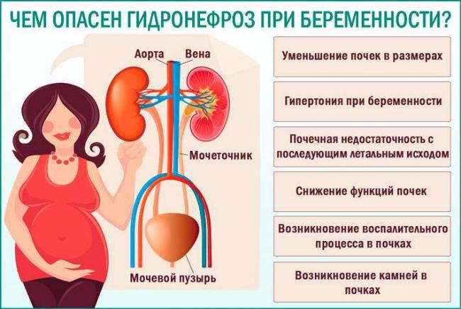 Chem-opasen-gidronefroz-pri-beremennosti.jpg
