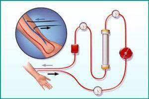 Arteriovenoznaja-fistula-300x200.jpg