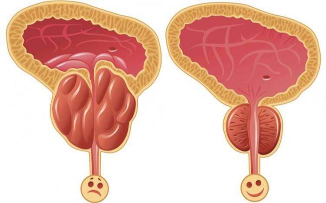 prostatit_750x469.jpg