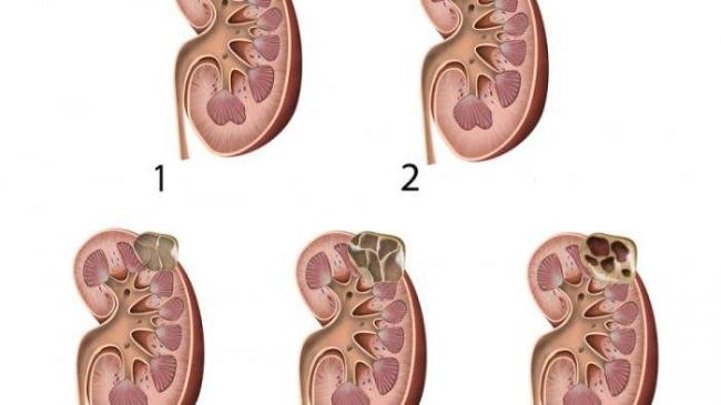 Классификация кист почек по Босниаку - Болезни почек человека ... Классификация кист почек по Босниаку - Болезни почек человека ...