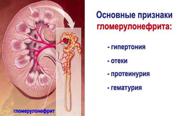 ospg-priznaki.jpg