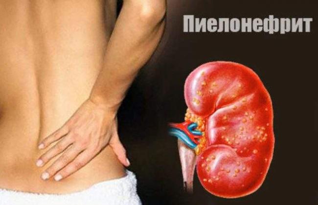 Osnovnym-priznakom-pielonefrita-vystupaet-yarkaya-vyrazhennost-boleznennogo-sindroma.-Istochnik-prettysecretsru.livejournal.com_.png