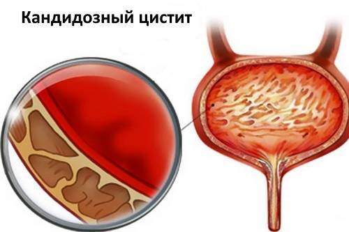 kandidoznyj-cistit-u-muzhchin.jpg