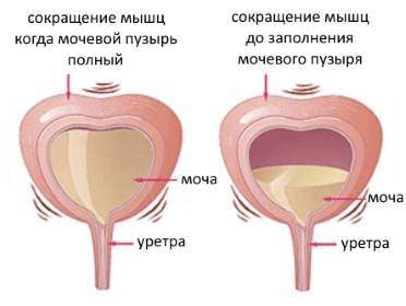 oshusheniepolnogomochevogopuziryabezbole_A9BE60A4.jpg