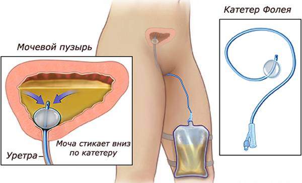 Катетеризация женщины
