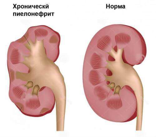 Oslozhneniya-pri-ne-lechenii-pochek.jpg