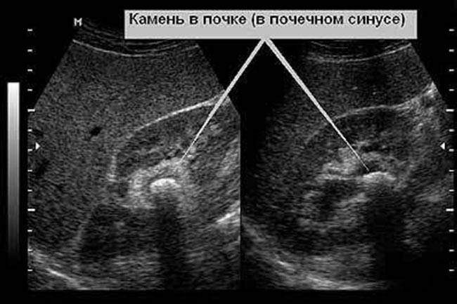 Ultrazvukovoe-izobrazhenie-pochek-32.jpg