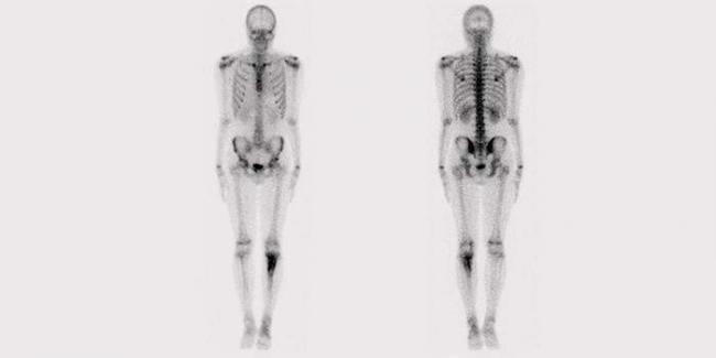 8478129-1chto-takoe-osteostsintigrafiya.jpg