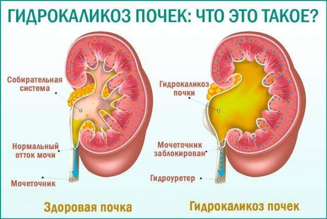 Gidrokalikoz-pochek-chto-jeto-takoe.jpg