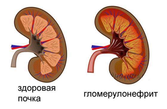 glomerulonefritis_560x367.jpg
