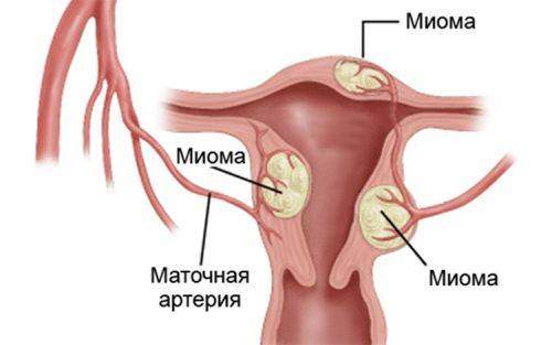 mioma_mat.jpg