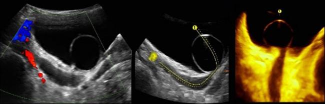 Ureterotsele-2.jpg