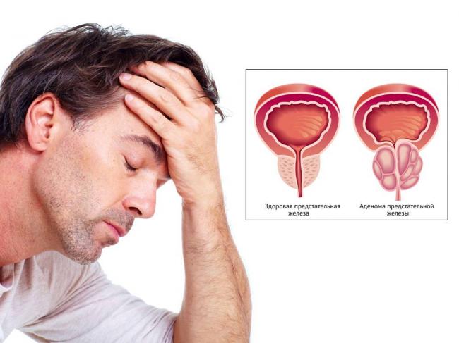 prostatit-u-muzhchin.jpg