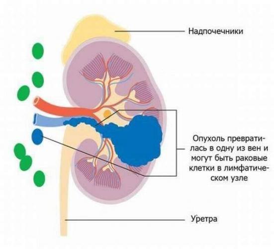 Опухоль почки