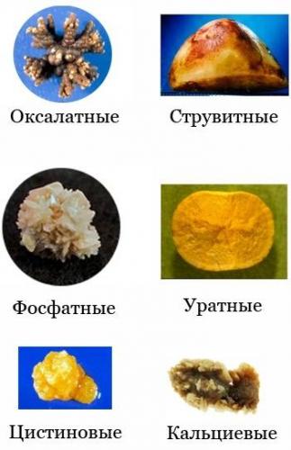 kamni-v-mochevom-puzyre-simptomy-1.jpg