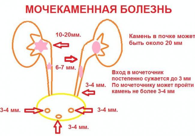 kamni-v-mochevom-puzyre-simptomy-3.jpg