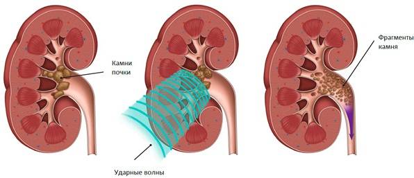 kamni-v-mochevom-puzyre-simptomy-10.jpg
