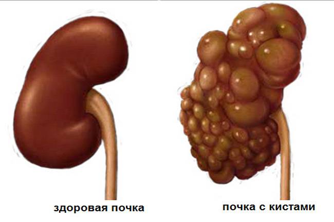Kista-na-pochke.jpg