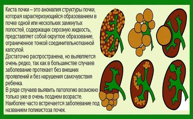 CHto-takoe-kista-na-pochke.jpg