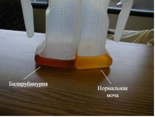 Bilirubin-in-Urine.jpg