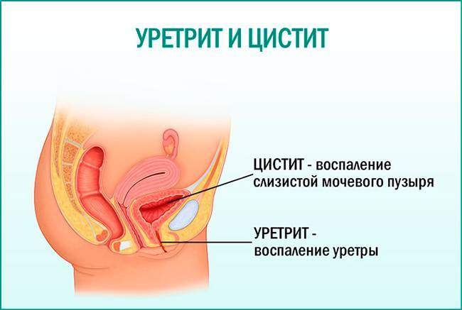 Uretrit-i-cistit.jpg