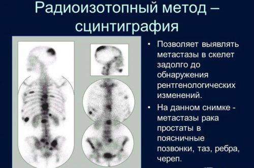 scintigrafija-kstsklt-1-500x331.jpg