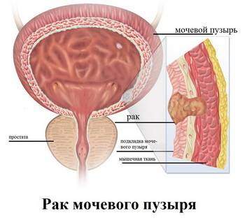 rak-mochevogo-puzyrya-u-zhenshhin.jpg
