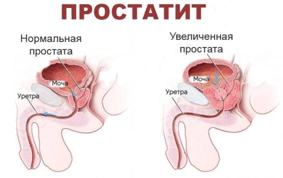prostatit.png