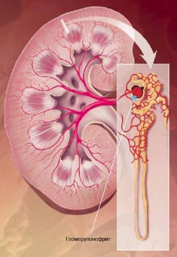 Porazhenie-pochechnyh-klubochkov-pri-glomerulonefrite.-Istochnik-tvoelechenie.ru_.jpg
