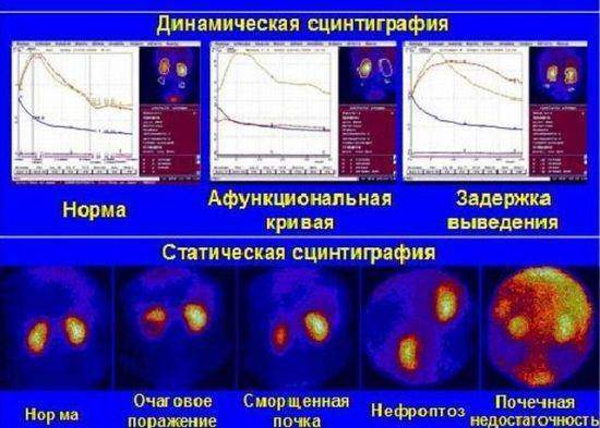 scintigrafija-poch-3-550x393.jpg