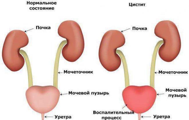 TSistit-priznaki-e1484151476856.jpg