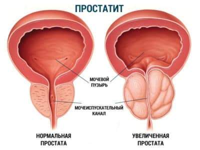 narodnoe-sredstvo-pri-lechenii-prostatita-3265-400x300.jpg