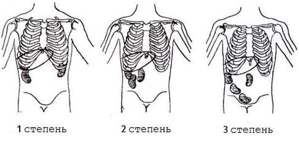 stepeni-nefroptoza.jpg