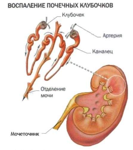 Glomerulonefrit.jpg