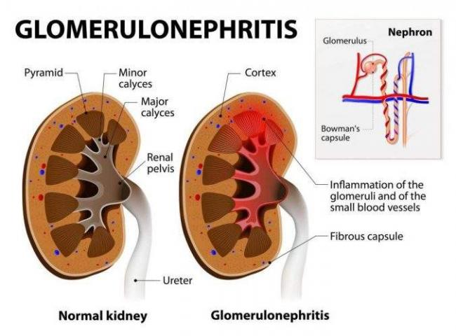 glomerulonefrit-1.jpg
