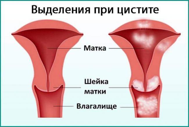 vydelenija-pri-cistite-u-zhenshhin-4.jpg